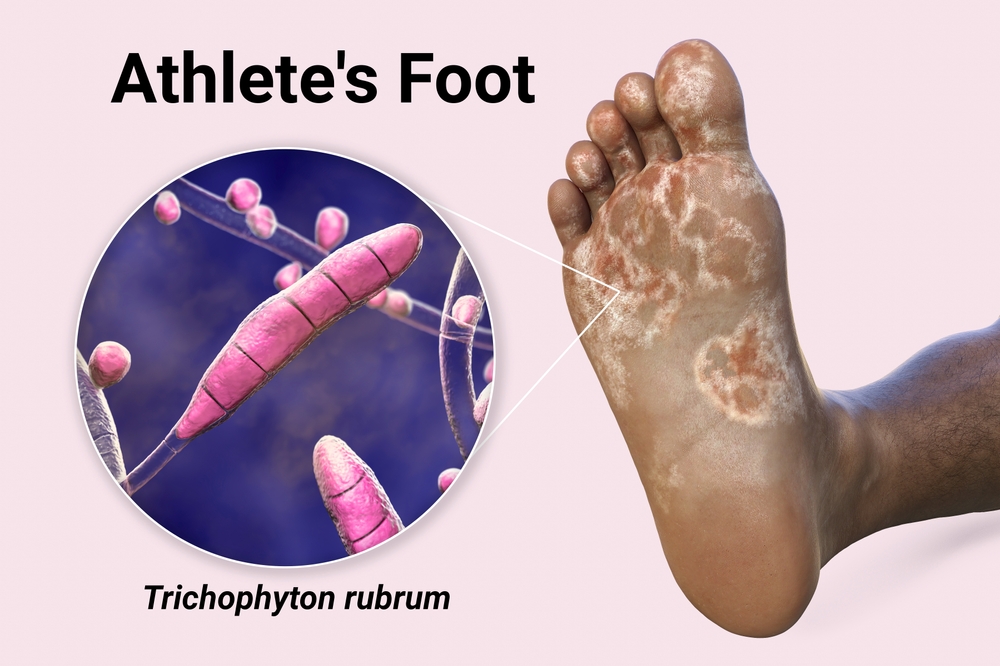 Athlete's foot