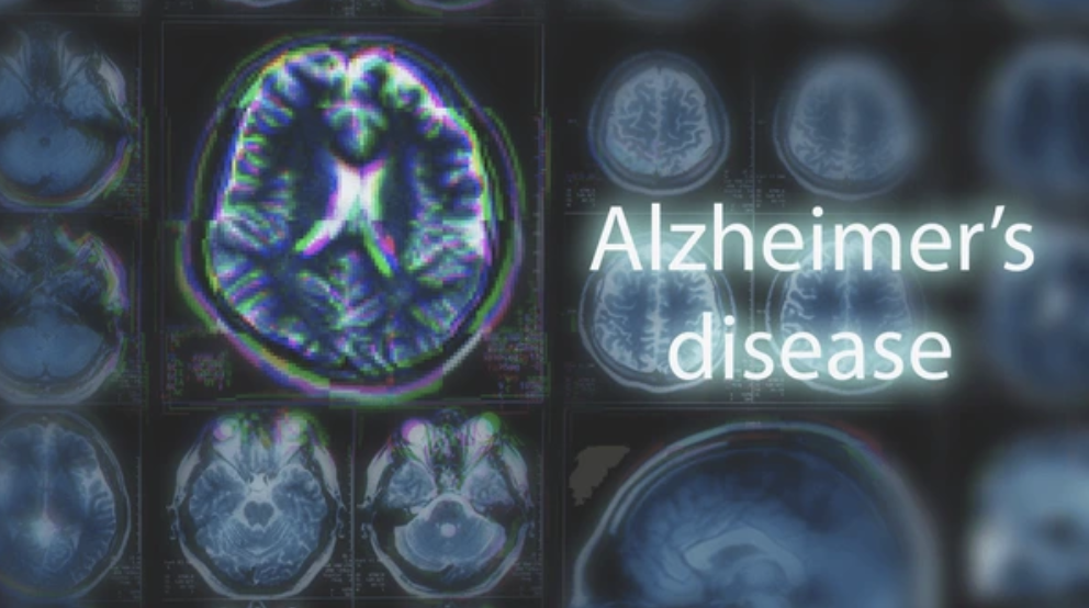 alzheimer's