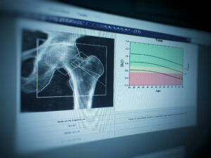 DEXA Scan, Bone Density