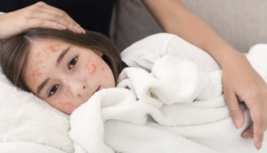 measles