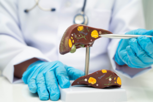 Liver cancer