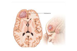 Glioblastoma