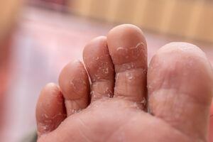 Athlete's Foot,