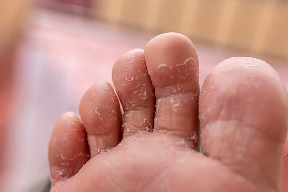 Athlete's Foot,