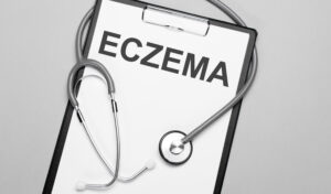 Eczema