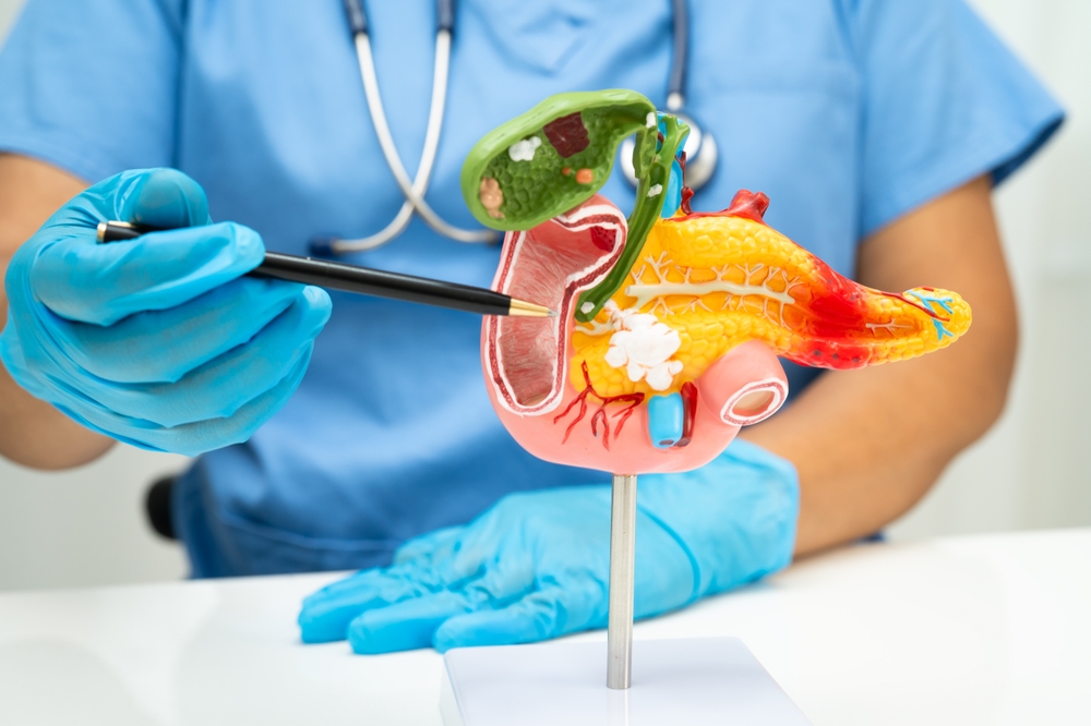 pancreatic cancer