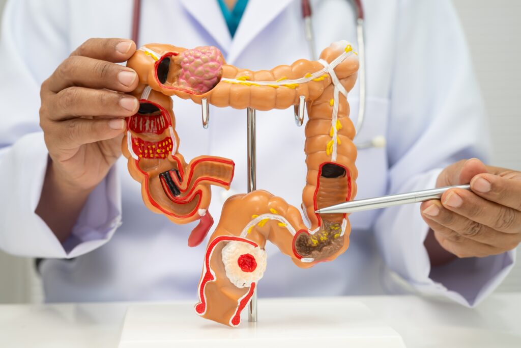 Colorectal cancer,