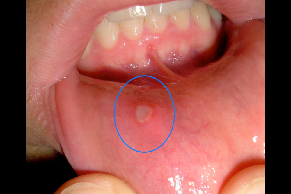 Ulcer
