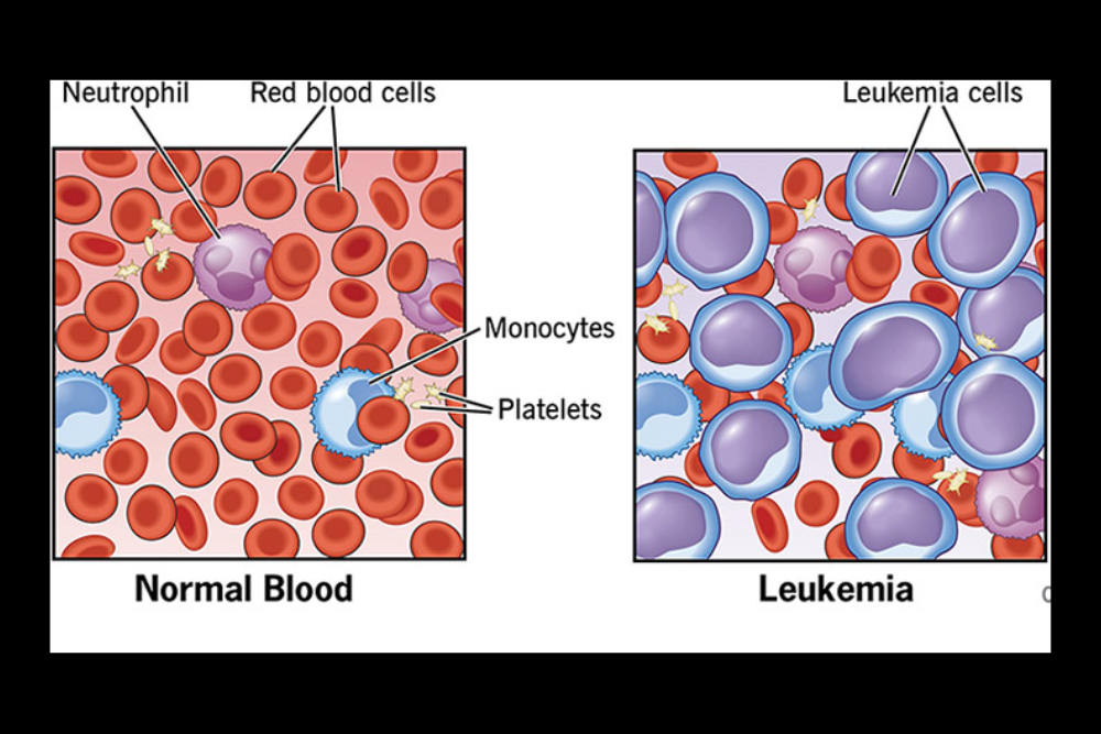 Leukemia