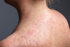 Skin rash