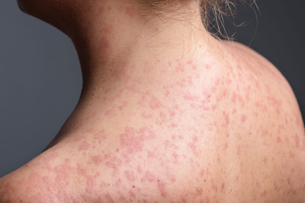 Skin rash
