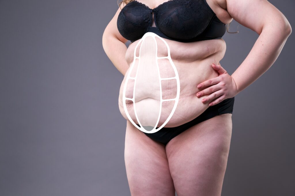 Diastasis recti