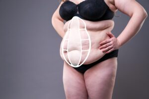 Diastasis recti