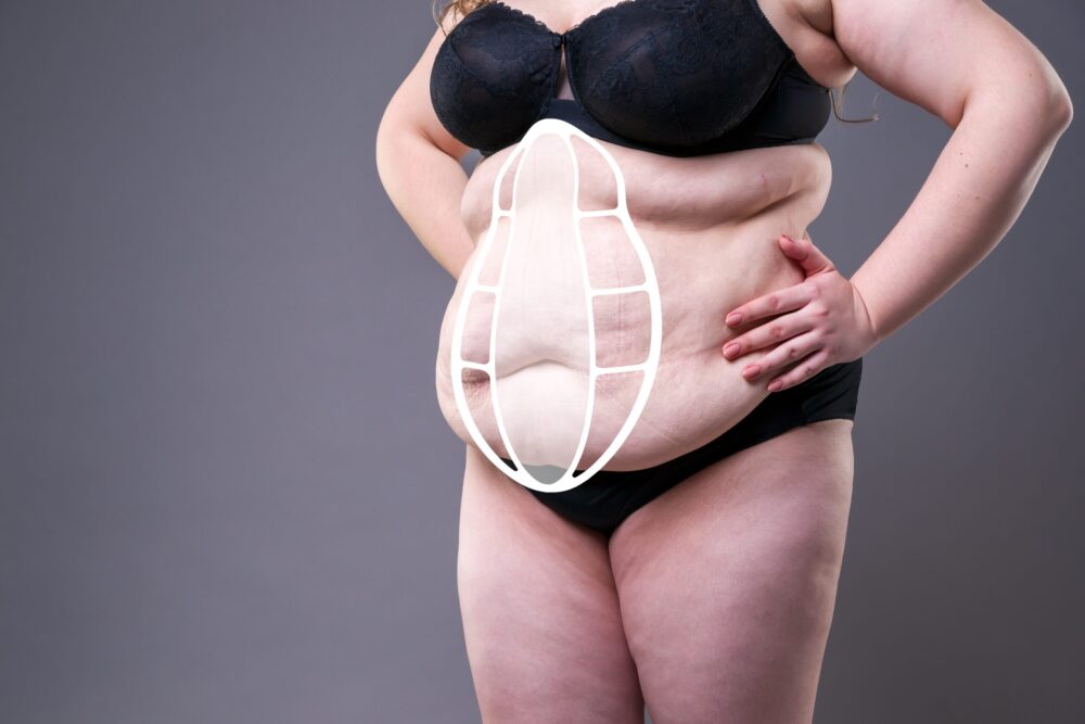 Diastasis recti