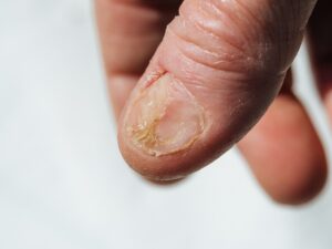 nail