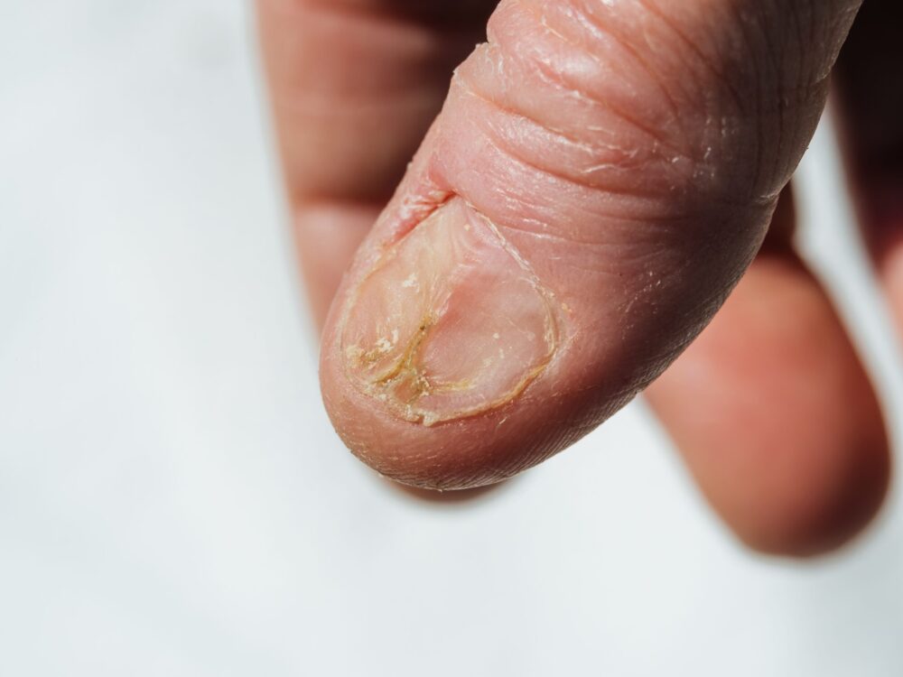 nail