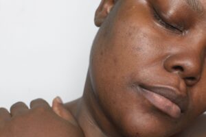 Hyperpigmentation, Melanin